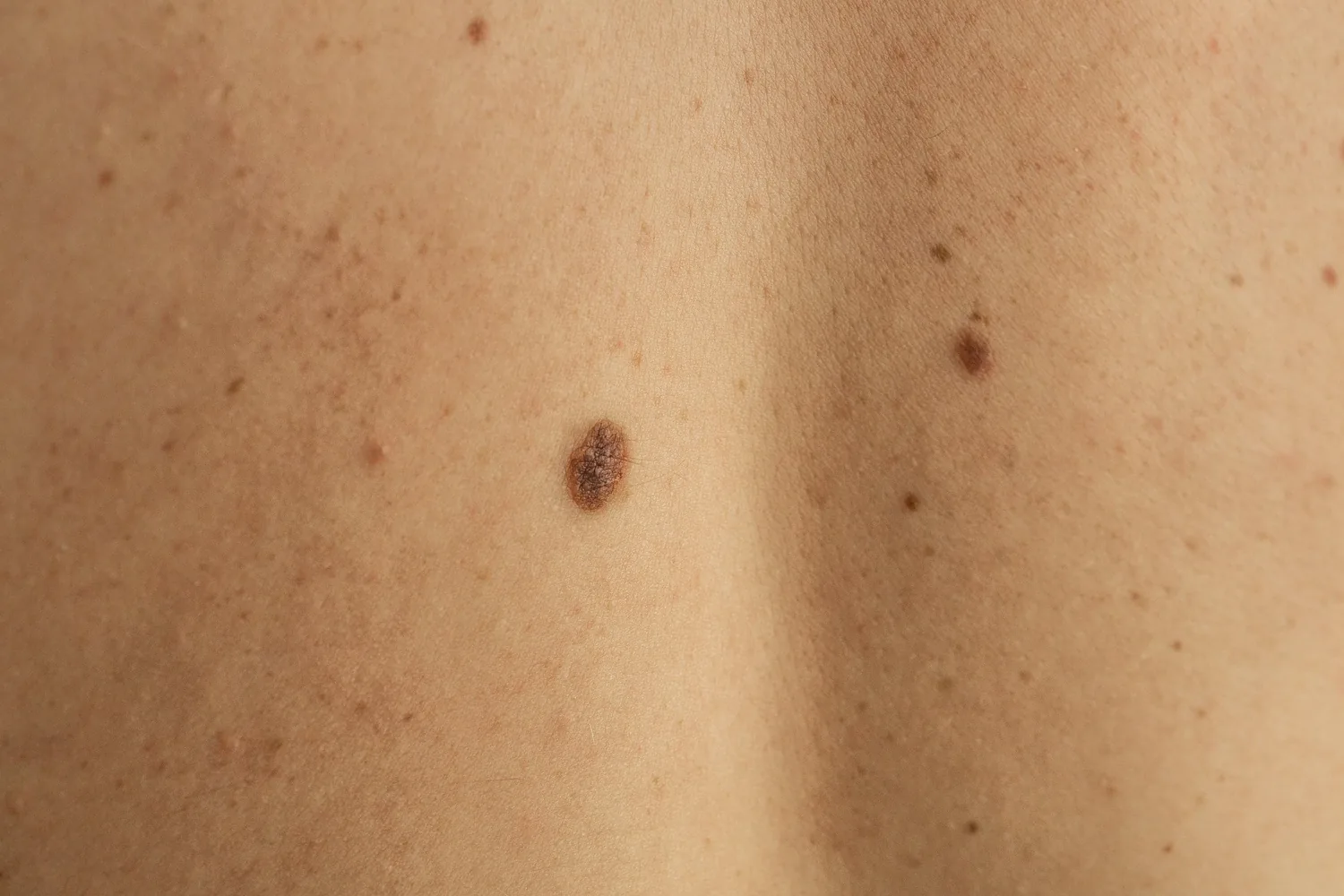 medical dermatology woman Several moles of different sizes on a person's back
